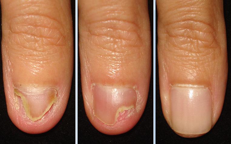 ANTI-FUNGAL NAIL REPAIR POLISH