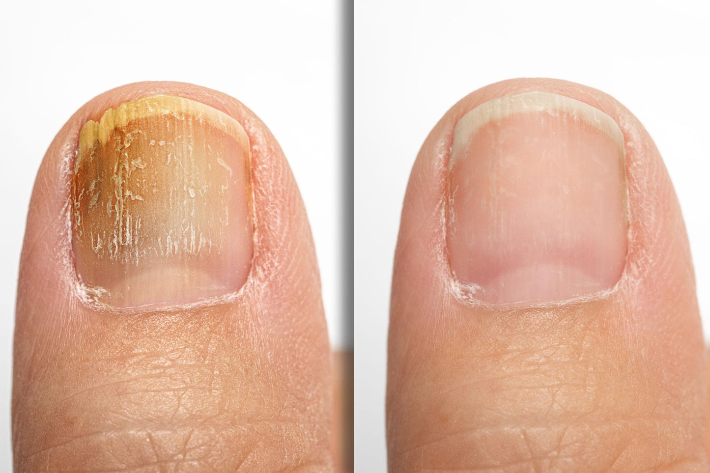 ANTI-FUNGAL NAIL REPAIR POLISH